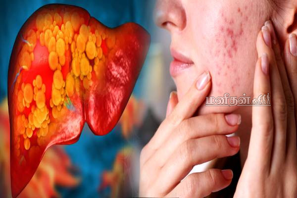 முகத்தில் இந்த அறிகுறி இருக்கா? கல்லீரல் பாதிப்பு உறுதி | Fatty Liver Symptoms Shows On Face