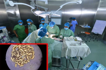 அறுவை சிகிச்சை மூலம் மூக்கில் இருந்து நீக்கப்பட்ட 150 புழுக்கள் (காணொளி)