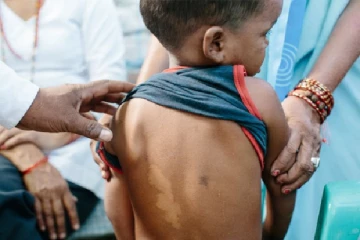 இலங்கையில் அதிகரிக்கும் தொழுநோய் -சிறுவர்களும் பாதிப்பு