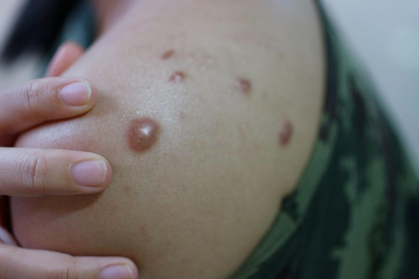 உலக நாடுகளை அச்சுறுத்தும் ஆபத்து - அவசரநிலையை அறிவித்த WHO | Monkey Pox Unitednations Who