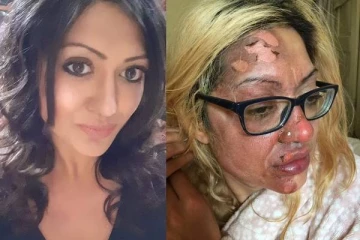 முட்டை வெடித்ததில் சிதைந்த அழகிய முகம்! பிரித்தானிய பெண்ணுக்கு நேர்ந்த பரிதாபம்- எச்சரிக்கை செய்தி