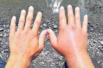 கை, கால் வீக்கத்துடன் பரவும் புதுவித காய்ச்சல்.., அச்சத்தில் ஆந்திர மக்கள்