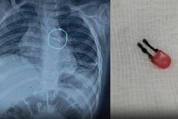 ஏழு நாட்களாகத் தொடர் இருமல்..குழந்தையின் மூச்சுக் குழாயில் LED -சாதுர்யமாக அகற்றிய அரசு மருத்துவர்கள்!