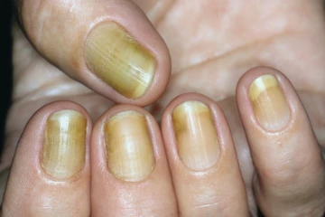 உங்கள் நகங்கள் மஞ்சள் நிறத்தில் காணப்படுதா? கவலைய விடுங்க!