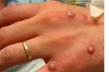 තවත් භයානක වෛරසයක් පැතිර යයි.. ලංකාවත් දැඩි අවධායෙන්..