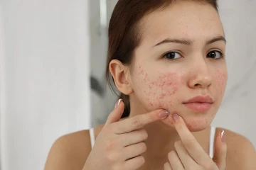 முகப்பரு இல்லாத முகம் வேண்டுமா? அப்போ இந்த இலையை இப்படி பயன்படுத்துங்க