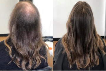 முடி அடர்த்தியாக வளர என்ன சாப்பிட வேண்டும்?