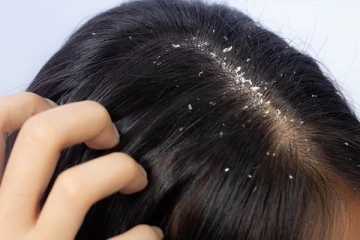 பொடுகு பிரச்சனையா? இதிலிருந்து எளிதில் விடுபட இதோ சில சூப்பரான டிப்ஸ்