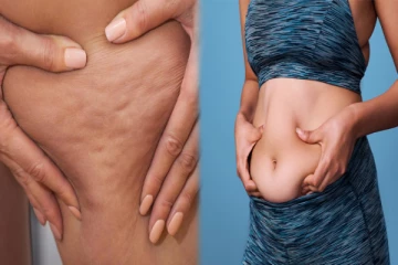 Cellulite Remedy: இடுப்பு, தொடை பகுதிகளில் உள்ள கொழுப்பை குறைக்க வீட்டு வைத்தியம்
