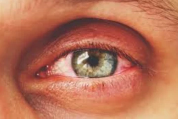 පැතිර යන භයානක ඇස් රෝගය - ලේන්සු පාවිච්චි කරන්නැයි උපදෙස්..