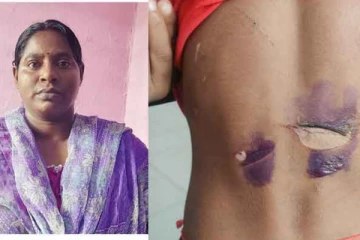 சிறுவர்களின் உடல் முழுவதும் சூடுவைத்த கொடுமைக்கார சித்தி - வேலூரில் பயங்கரம்