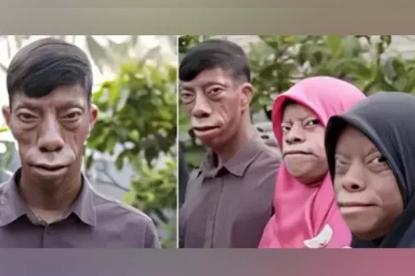 பகலில் சாதாரண மனிதன், இரவில் பல்லி முகம் கொண்ட மனிதன்! இந்தோனேசியாவில் ஆச்சரியம் | Indonesia Man Affected With Strange Face Disease