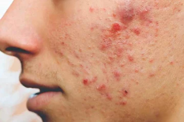 முகப்பருவா? கவலையை விடுங்க.. இதனை எளியமுறையில் போக்க இதோ சில அற்புத டிப்ஸ்!