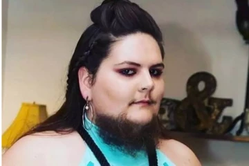 13 வயதில் இருந்து முகத்தில் வளரும் தாடி! சங்கடங்களை மீறி மகிழ்ச்சியோடு ஏற்று கொண்ட அழகிய இளம்பெண்