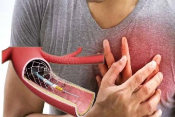 “ஸ்டென்ட்” குழாய்கள் தட்டுப்பாடு : இருதய நோயாளர்கள் பாதிப்பு