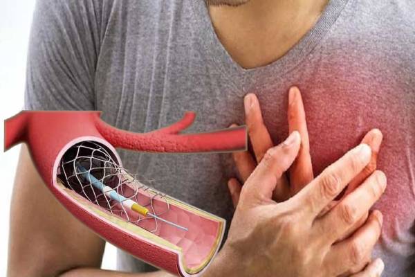 “ஸ்டென்ட்” குழாய்கள் தட்டுப்பாடு : இருதய நோயாளர்கள் பாதிப்பு - ஐபிசி தமிழ்