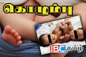 இலங்கையில் வயிற்றுப் பகுதியால் ஒட்டி பிறந்த இரட்டையர்கள்