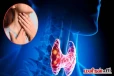 அலட்சியப்படுத்தவே கூடாத தைராய்டு புற்றுநோயின் ஆரம்ப அறிகுறிகள்!
