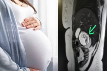 முதல் முறையாக கர்ப்பப்பைக்கு பதிலாக கல்லீரலில் வளரும் கரு - குழந்தை பிறப்பு சாத்தியமா?