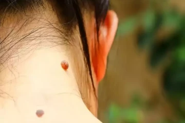 முகம், கழுத்து என மரு அசிங்க படுத்துகிறதா? வலிக்காம உதிர இந்த சாதாரண உணவு பொருட்கள் போதும்!