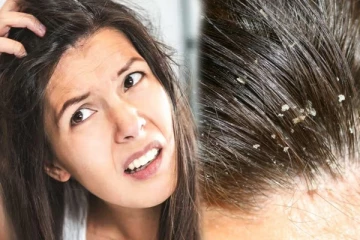 பொடுகு தொல்லைக்கு அஞ்சத்தேவையில்லை! எளிய பாட்டி வைத்தியம் செய்து பாருங்க