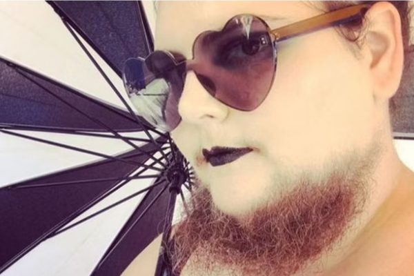 17 வருடங்களாக முகத்தில் தாடியுடன் இளம்பெண் - காரணம் இதுதான்! | American Bearded Woman