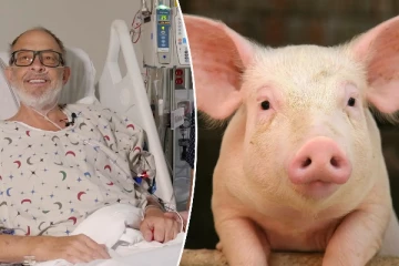 பன்றியின் இதயம் பொருத்தப்பட்ட இரண்டாவது நபரும் உயிரிழப்பு