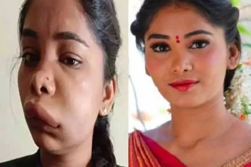 பல் வலிக்காக ஊசி போட்ட நடிகை? வெளியில் முகம் காட்ட முடியாமல் தவிக்கும் நிலை