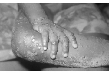 குரங்கம்மை -  பொது சுகாதார அவசரநிலையாக அறிவிப்பு!