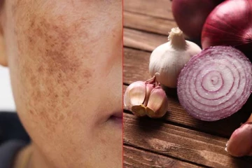 முகத்தில் கரும்புள்ளியால் அவதிப்படுகிறீர்களா? இந்த இரண்டு பொருள் பேதும்