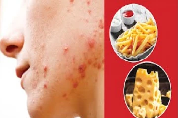 කුරුලෑ වලින් මිදීමට ඔබ නොගත යුතු ආහාර ගැන ඔබ දන්නවාද...?