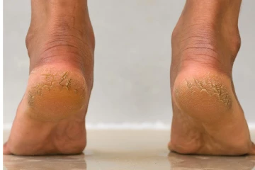 காலின் அழகைக் கெடுக்கும் குதிகால் வெடிப்புக்கு முற்றுப்புள்ளி! இதோ சூப்பர் டிப்ஸ்