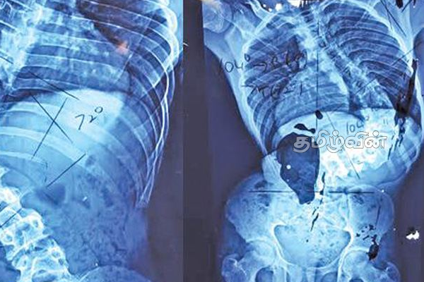 பதுளையில் நடத்தப்பட்ட அபூர்வ சத்திர சிகிச்சை | A Rare Surgical Procedure Performed In Badula