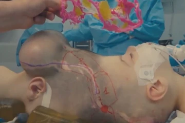 விடிய விடிய நடந்த அறுவை சிகிச்சை! ஒட்டி பிறந்த தலையை பிரித்த மருத்துவர்கள்