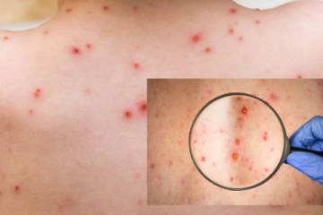 වඳුරු උණ (Monkeypox) පැතිරයාම ගැන ජපුර සරසවියෙන් අනාවරණයක්