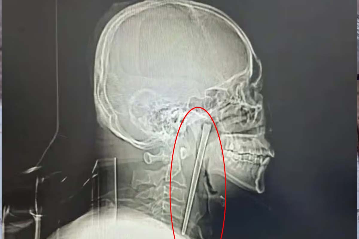 நூடுல்ஸ் சாப்பிட்ட நபருக்கு நேர்ந்த சோகம்! 8 ஆண்டாக தொண்டையில் இருந்த சாப்ஸ் ஸ்டிக் | Man 12 Cm Metal Chopstick Lodged In Throat