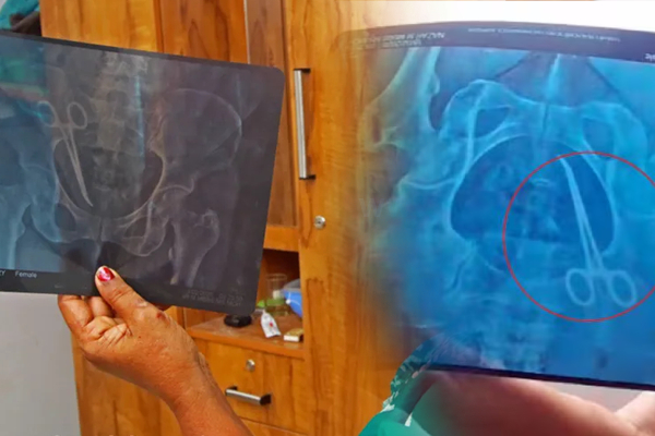 வயிற்றில் 10 செ.மீ கத்தரிக்கோல்! சத்திரசிகிச்சையால் நேர்ந்த விபரீதம் | 10 Cm Scissors In The Abdomen Of A Woman