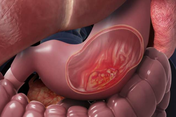 புளித்த உணவுகள் சாப்பிட்டால் புற்றுநோய் வராதா? மருத்துவ விளக்கம் | Fermented Foods Prevent Cancer Surgeon Explains புளித்த உணவுகள் சாப்பிட்டால் புற்றுநோய் வராதா? மருத்துவ விளக்கம் | Fermented Foods Prevent Cancer Surgeon Explains