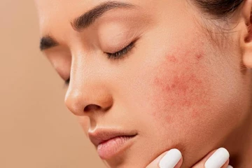 பருவினால் ஏற்பட்ட அசிங்கமான  தழும்புகள் மறைய வேண்டுமா? இதை செய்தாலே போதும்!