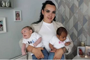 மில்லியனில் ஒருத்தருக்கு தான் இப்படி நடக்கும்! வியக்க வைத்த அபூர்வ இரட்டை குழந்தைகள்