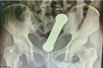 இன்பத்திற்காக முதியவர் செய்த பகீர் செயல்! ஸ்கேன் ரிப்போர்டை கண்டு ஆடிப்போன மருத்துவர்கள்