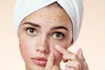 தொல்லையை தரும் முகப்பரு பிரச்சினையிலிருந்து உடனடி விடுதலை வேண்டுமா?