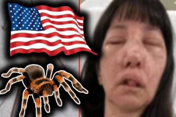 அமெரிக்காவில் விஷ சிலந்தி கடித்த பெண்ணுக்கு நேர்ந்த கதி