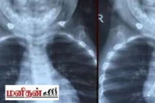 வடிவேலு பட காமெடி போல் எல்.இ.டி பல்பை விழுங்கிய சிறுவன்.. அதிர்ச்சியில் மருத்துவர்கள்