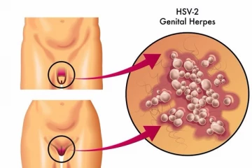 ලිංගික හර්පීස් සුව කළ නොහැකිද?