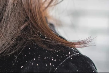 பொடுகு தொல்லை அடியோடு விரட்ட வேண்டுமா? இதோ சில அற்புத வழிகள்