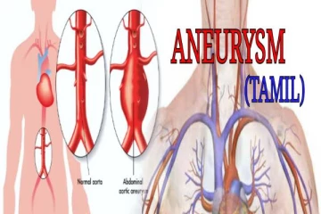 பெருநாடி அனீரிசம்(Aortic Aneurysm): அறிகுறிகளும், சிகிச்சைகளும்
