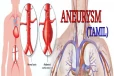 பெருநாடி அனீரிசம்(Aortic Aneurysm): அறிகுறிகளும், சிகிச்சைகளும்