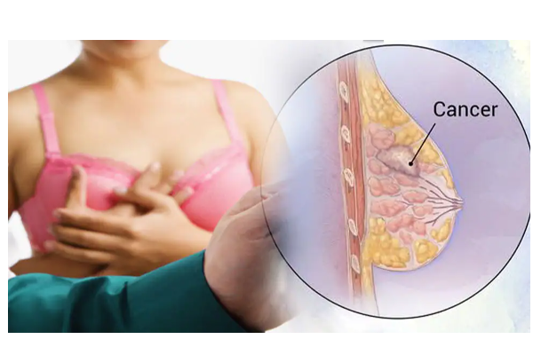 மார்பக புற்று நோய் ஏற்பட காரணங்களும்... அறிகுறிகளும்.... - பெண்களே உஷார் - தமிழ்நாடு