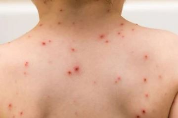 இலங்கையில் அடையாளம் காணப்பட்ட குரங்கம்மை தொற்றாளர்! சுகாதார அமைச்சின் விசேட அறிவிப்பு